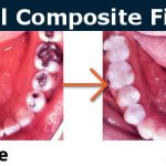 https://mydentistburbank.com/wp-content/uploads/2018/02/composite3-150x150.jpg