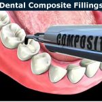 https://mydentistburbank.com/wp-content/uploads/2018/02/composite4-150x150.jpg