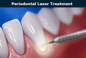 Periodontal Laser Treatment