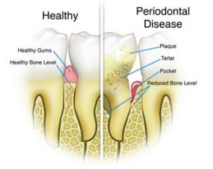 Healthy vs Gum Disease Tooth