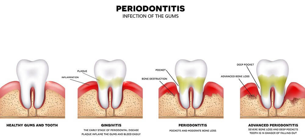 Periodontal Disease Stages