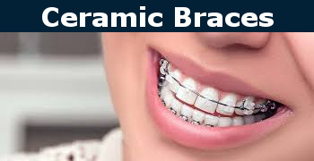 How to Speed Up Your Braces Process