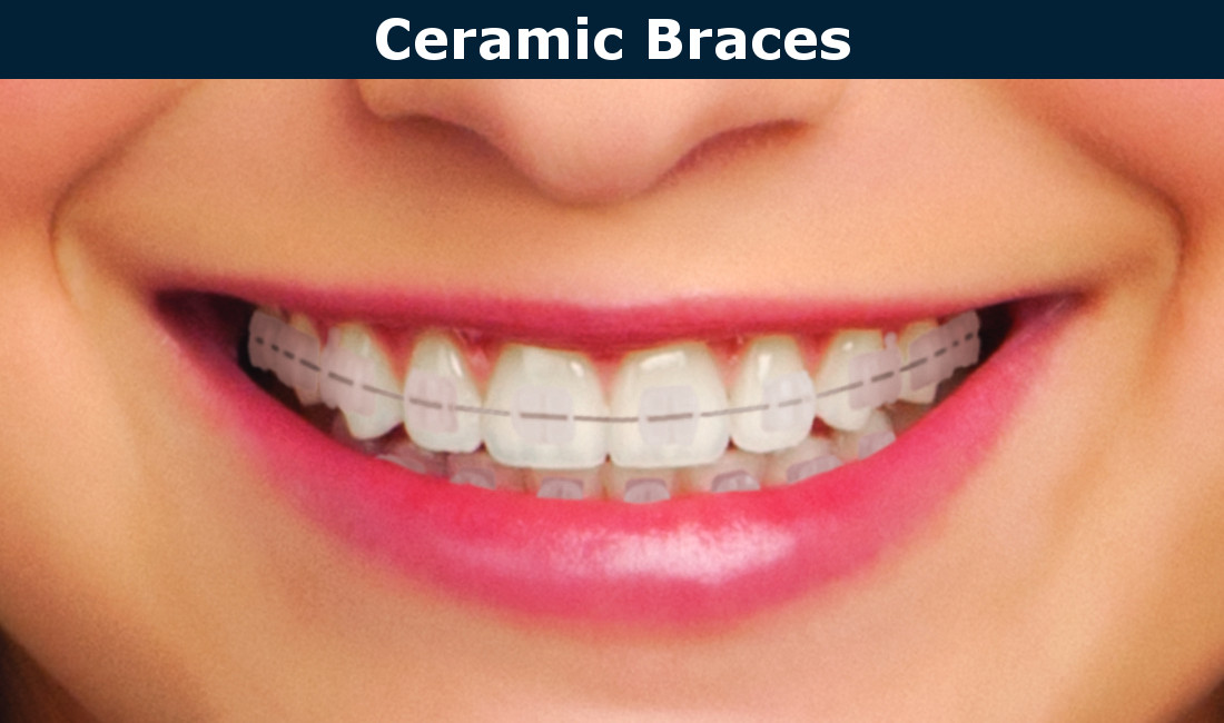 Ceramic braces in Burbank