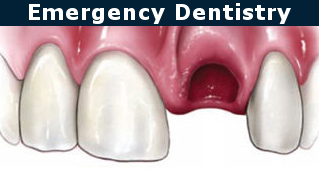 Knocked Out Tooth Emergency Dentistry