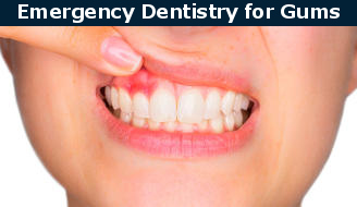 Swollen gums dental emergency