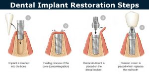 Dental implantation steps