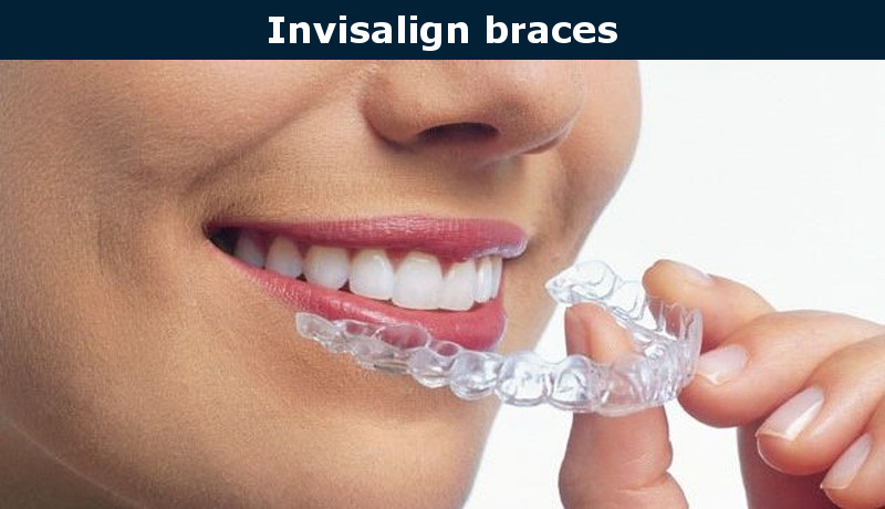 Invisalign braces