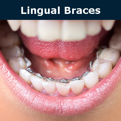 Lingual braces