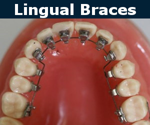 Braces Burbank: Metal, Ceramic, Invisalign