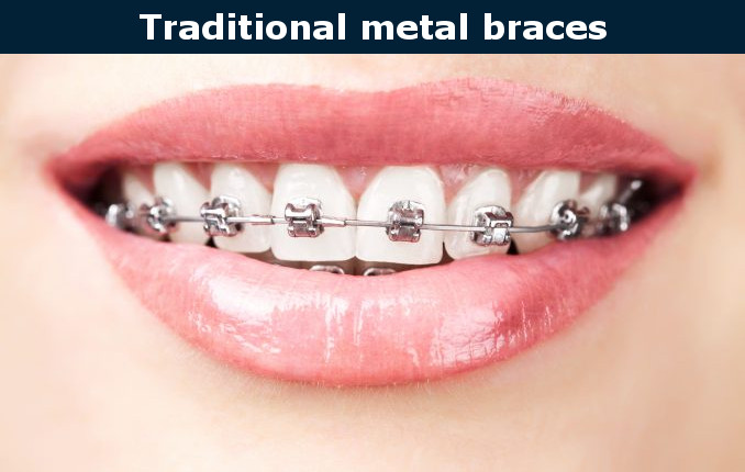 Traditional metal braces