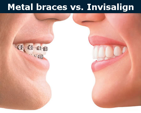 Metal Braces vs Invisalign Clear Aligners 