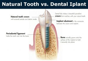 Healthy tooth vs dental implant