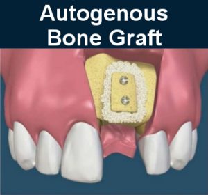 Bone Grafting Burbank | My Dentist Burbank