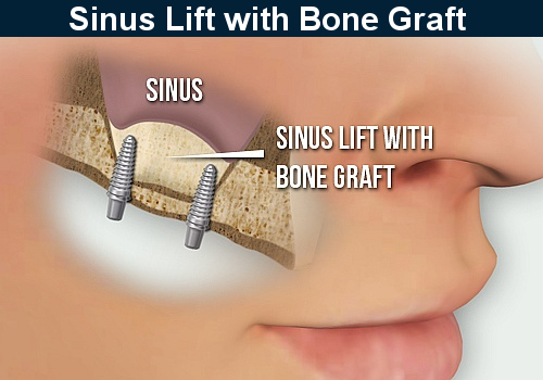 Sinus Lift and Sinus Graft