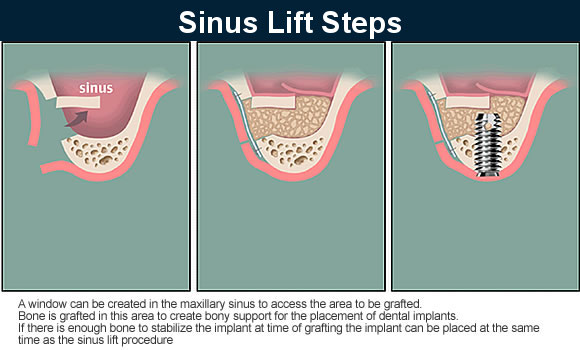 Stages of Sinus Lifting