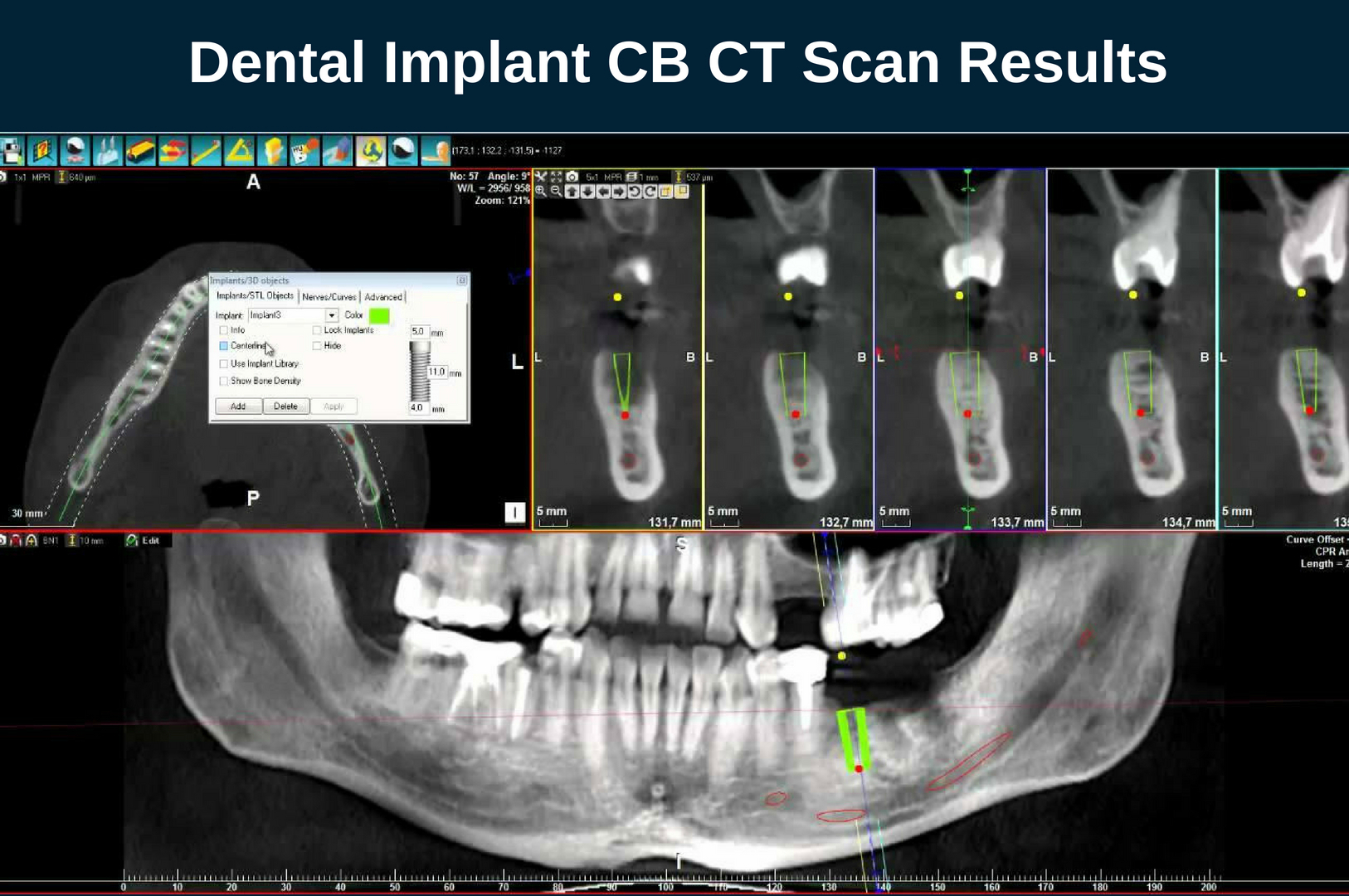 Dental Implant CB CT Scan Results