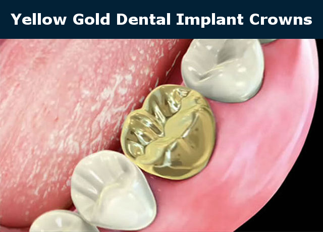 Yellow Gold Dental Implant Crown