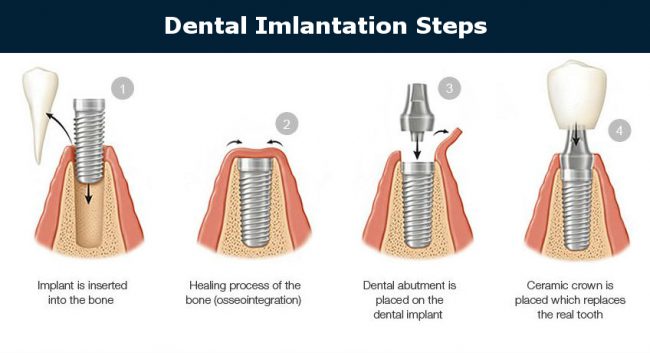 Dental Implantation Steps