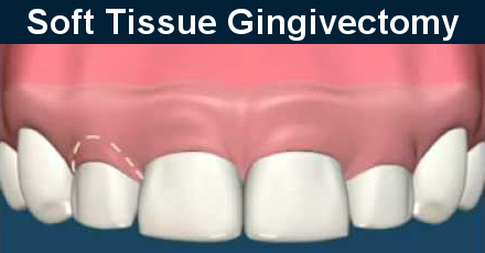 Soft tissue gingivectomy