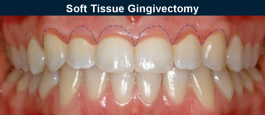 Soft Tissue Gingivectomy