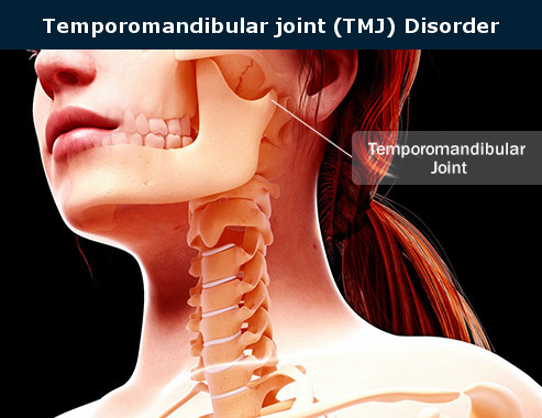 TMJ disorder
