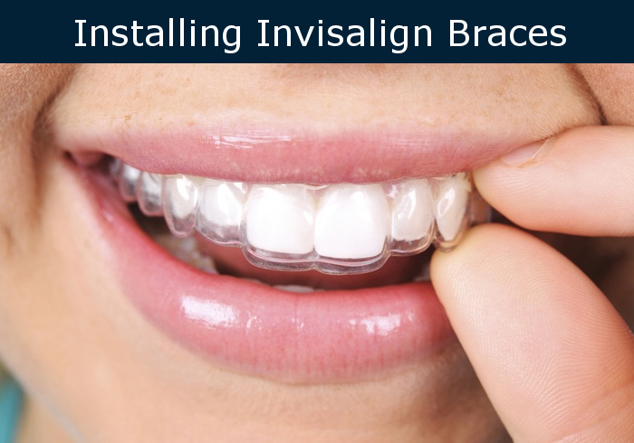 wearing invisalign braces