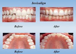 invisalign imageages of before and after