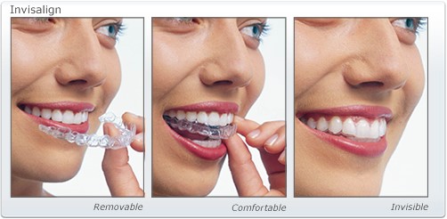 how do you use invisalign