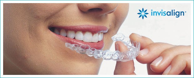 invisalign aligners