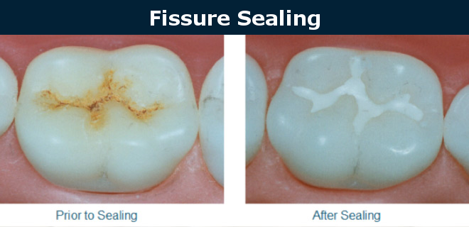 preventive dentistry fissure sealing
