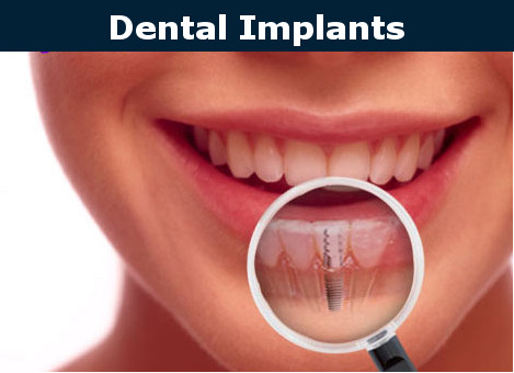 Cosmetic Dentistry Dental Implants