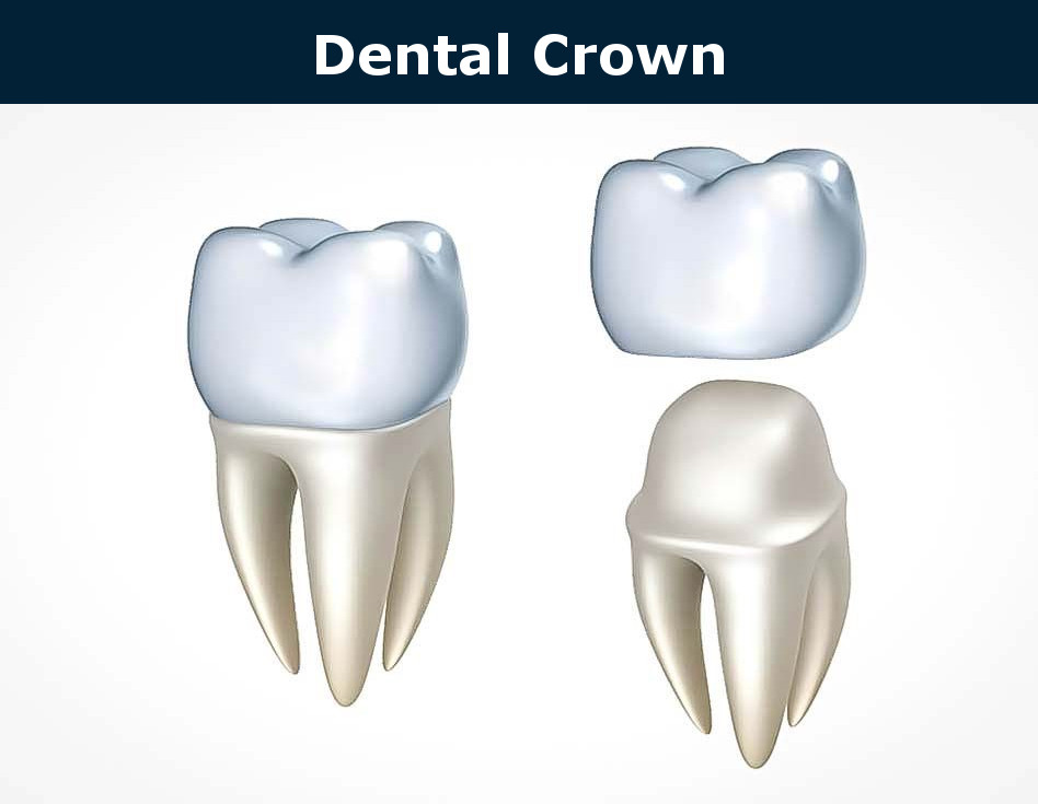 dental crowns