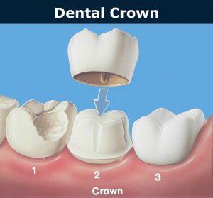 dental corwns installation