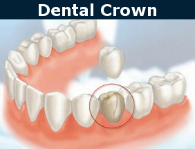 dental crowns