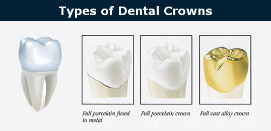 types of dental crowns