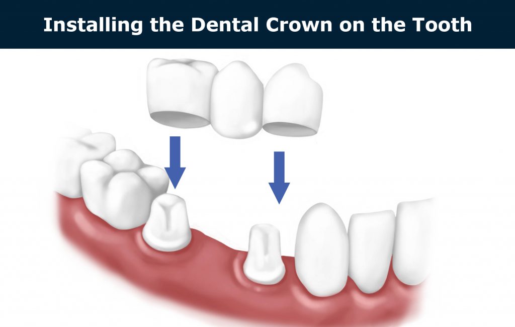 installing the dental crown