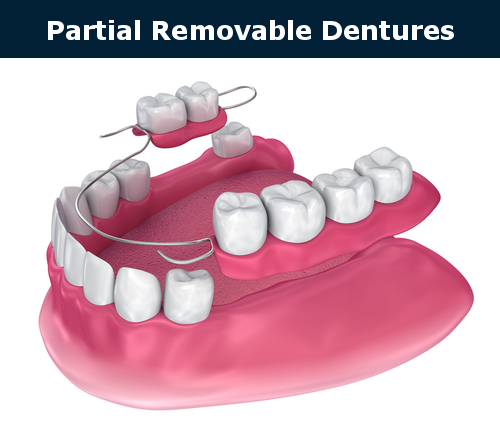 Partial removable denture