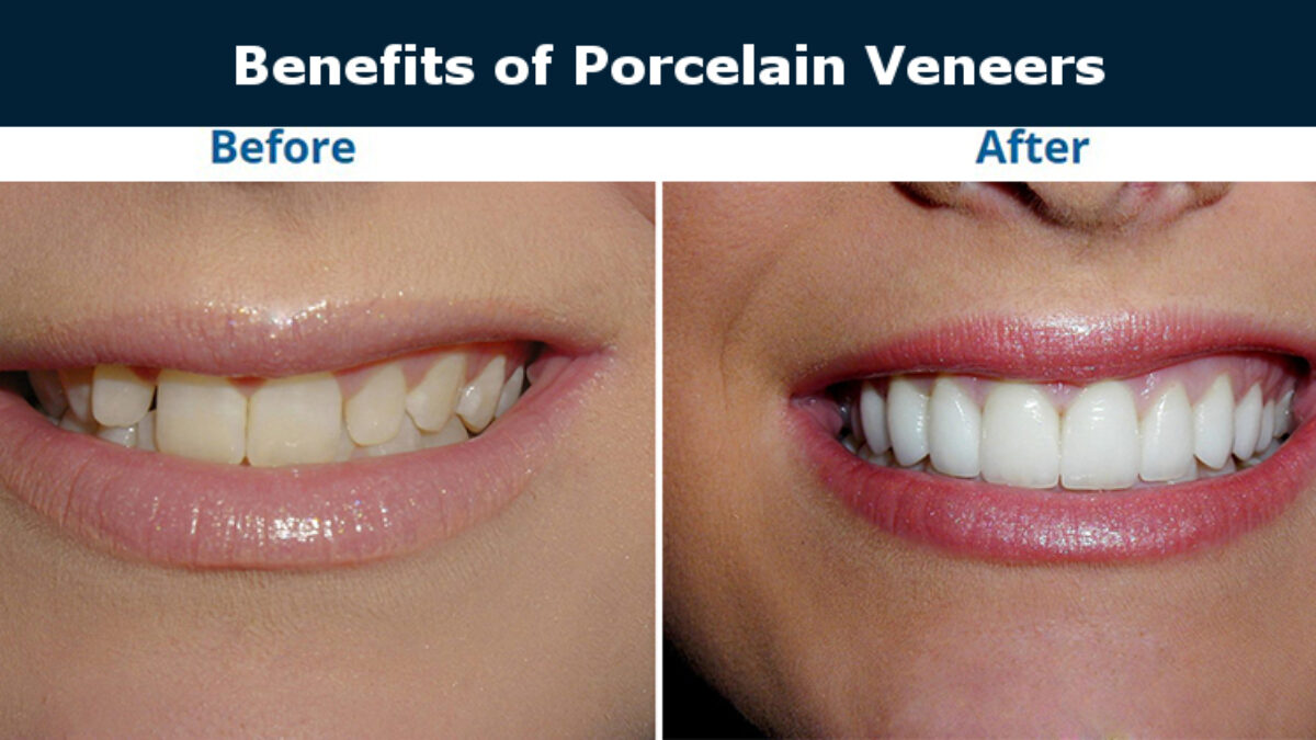 Porcelain Veneers Near Me Uniondale thumbnail
