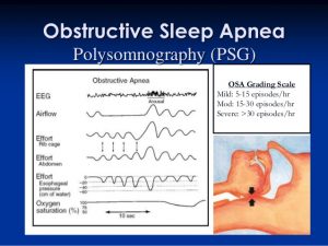 Polysomnography