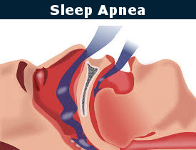 Sleep Apnea Burbank