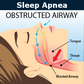 Sleep Apnea