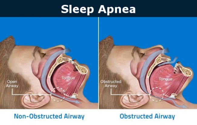 Sleep Apnea Burbank | My Dentist Burbank