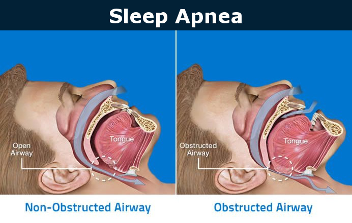 Sleep Apnea