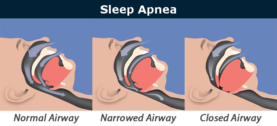 Sleep Apnea