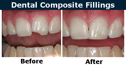 Composite (White) Fillings before after