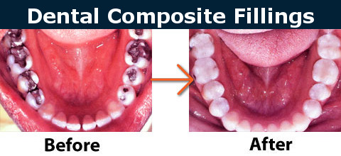 Composite (White) Fillings