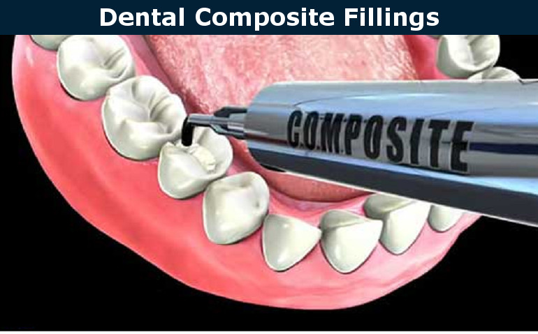 Composite (White) Fillings