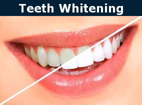 Teeth Whitening Before and After