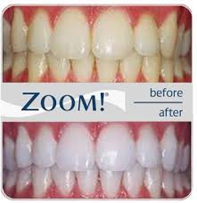 Zoom Teeth Whitening