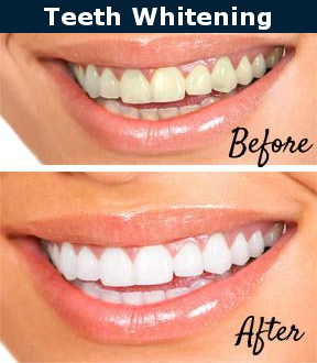 Teeth Whitening